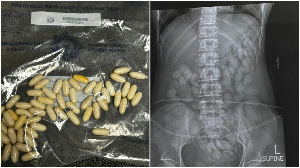 Namibian drug mule stomach