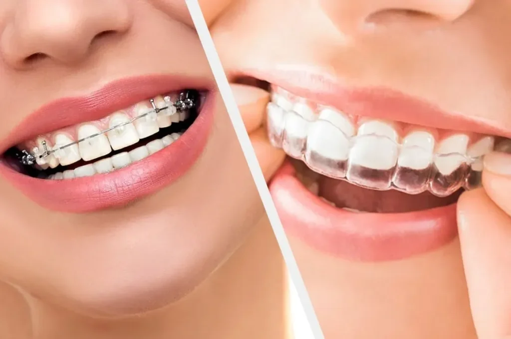 Invisalign vs traditional braces: which one is right for you?